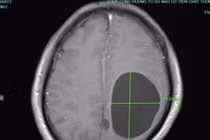 Thích tiết canh, rau sống quý ông liệt nửa người vì đa kén sán não