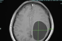 Thích tiết canh, rau sống quý ông liệt nửa người vì đa kén sán não