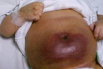 Cứu trẻ sơ sinh khít hẹp đường thở, u máu khổng lồ do hội chứng Kasabach-Merit