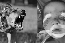 Trẻ 3 tuổi bị chó cắn rách mặt: 100% không tiêm phòng dại sẽ chết