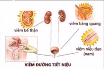 Bác sĩ mách chị em cách tránh viêm đường tiết niệu trời nồm ẩm