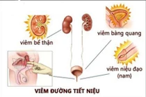 Bác sĩ mách chị em cách tránh viêm đường tiết niệu trời nồm ẩm