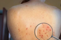 Phát hiện ca đậu mùa khỉ thứ 6, tiết lộ kiểu gen nội địa đầu tiên