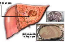 Áp-xe gan nguy kịch vì tưởng sốt thông thường