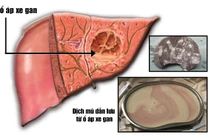 Áp-xe gan nguy kịch vì tưởng sốt thông thường