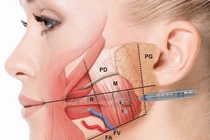 Tiêm botox chống nhăn, gọn mặt