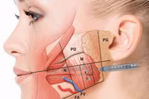 Tiêm botox chống nhăn, gọn mặt