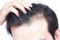 Hói đầu, rụng tóc ở nam giới trẻ, dấu hiệu cảnh báo từ hormone, stress?