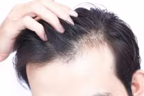 Hói đầu, rụng tóc ở nam giới trẻ, dấu hiệu cảnh báo từ hormone, stress?