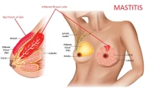  Viêm tuyến vú ở phụ nữ có thể gây biến chứng nguy hiểm 