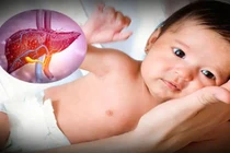 Nguy cơ viêm gan bí ẩn ở trẻ em, dấu hiệu cần lưu ý
