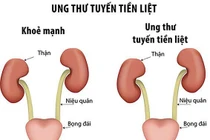 Quá trình chẩn đoán ung thư tuyến tiền liệt mất bao lâu?