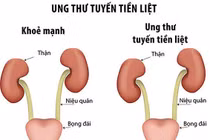 Quá trình chẩn đoán ung thư tuyến tiền liệt mất bao lâu?