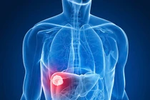 Dấu hiệu ung thư gan không nên bỏ qua