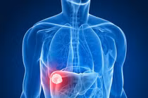 Dấu hiệu ung thư gan không nên bỏ qua