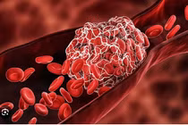 Bác sĩ cảnh báo điểm đau gây tắc nghẽn mạch máu nguy hiểm