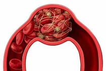 Hình thành cục máu đông hệ lụy báo động cho sức khỏe