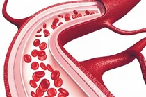 Bất thường ở tay, chân cảnh báo các cục máu đông "lẩn trốn" khắp cơ thể