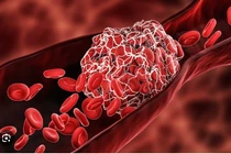 Bác sĩ cảnh báo điểm đau gây tắc nghẽn mạch máu nguy hiểm