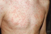 Nhiễm sởi, rubella... cẩn thận di chứng nặng suốt đời