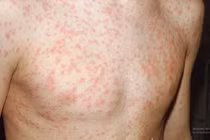 Nhiễm sởi, rubella... cẩn thận di chứng nặng suốt đời