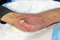 Người đàn ông biến chứng suy tuyến thượng thận do lạm dụng thuốc chứa corticoid