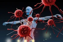 Ung thư phổi: phát hiện sớm có thể điều trị khỏi hoàn toàn