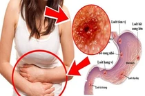 Những yếu tố khiến viêm dạ dày chuyển biến ung thư