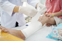 Trong khuôn khổ hợp tác nghiên cứu giữa bệnh viện Chợ Rẫy và Viện CSIRO (Úc) 2 bên đã thống nhất tiến hành thiết kế và in mảnh ghép cá thể hoá sản để điều trị cho bệnh nhân bị mất một đoạn xương dài do gẫy hở nhiễm trùng.