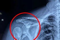 Điện giật té ngã vỡ nát khớp vai