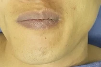 Giải ép vi mạch điều trị co giật nửa mặt 