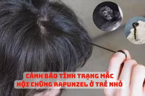 Tắc ruột do “hội chứng ăn tóc”