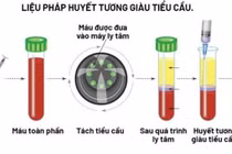 Huyết tương giàu tiểu cầu trị viêm khớp, viêm gân
