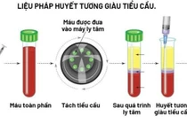 Huyết tương giàu tiểu cầu trị viêm khớp, viêm gân