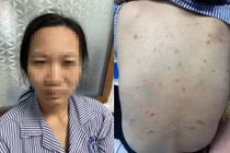 Nhiều người mắc thủy đậu… cẩn thận biến chứng đe dọa tính mạng