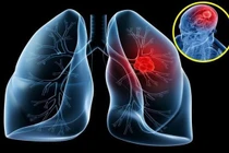 2% ung thư phổi phát hiện muộn sống trên 5 năm: phát hiện sớm cách nào?