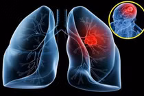 2% ung thư phổi phát hiện muộn sống trên 5 năm: phát hiện sớm cách nào?