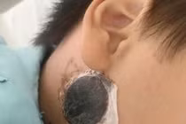 Nguy kịch do viêm não vì điều trị quai bị tại nhà