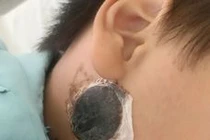 Nguy kịch do viêm não vì điều trị quai bị tại nhà