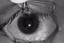 Người đàn ông nhập viện với đoạn dây thép xuyên nhãn cầu