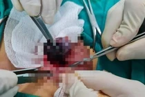 24 ca xoắn tinh hoàn trong hơn 3 tháng: Nhiều ca hoại tử phải cắt bỏ