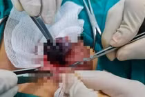 24 ca xoắn tinh hoàn trong hơn 3 tháng: Nhiều ca hoại tử phải cắt bỏ