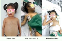 Ca ghép gan đặc biệt cho bệnh nhi có bất thường về mạch máu hiếm gặp