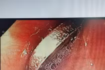 Bé 6 tuổi nuốt đồng xu chơi game vào thực quản