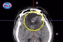 Định vị thần kinh lấy trọn khối u màng não nền sọ kích thước khổng lồ
