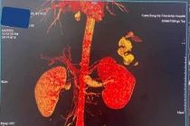 Nút mạch cầm máu cứu học sinh bị bạn đâm thủng thận trong gang tấc