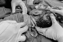 Dây rốn quấn cổ 3 vòng, xử trí thế nào để an toàn thai nhi?