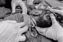 Dây rốn quấn cổ 3 vòng, xử trí thế nào để an toàn thai nhi?