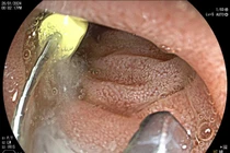 Đi chữa răng trẻ 5 tuổi nuốt cả cây kim 2,5 cm vào bụng