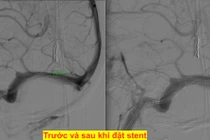 Nữ bệnh nhân lần đầu có giấc ngủ ngon sau 14 năm đau đầu, ù tai